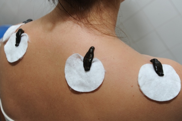 Гирудотерапия (пиявки)