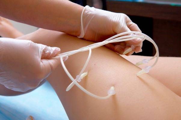 Процедура озонотерапи