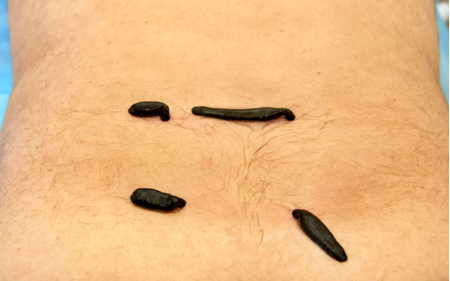 Гирудотерапия в санатории «Жемчужина Кавказа» в Ессентуках